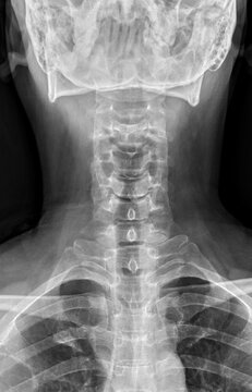 X-ray of cervical spine in anteroposterior position