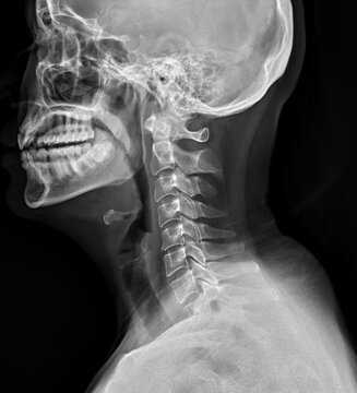 X-ray of cervical spine in lateral position
