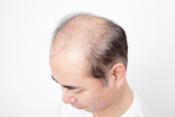 Fototapeta premium 薄毛の男性