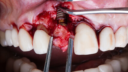 bone fragment to be added to the area of the central tooth after implantation