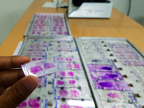 hand holding histopathology slides stained with leishman stain with selective focus on hand held slide