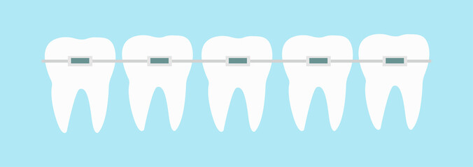 Five teeth with dental braces line vector illustration. Orthodontic treatment