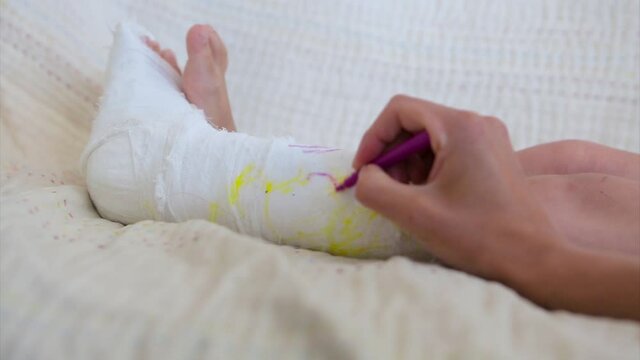 broken leg. damage to the bones. a child paints a plaster. a girl with a marker