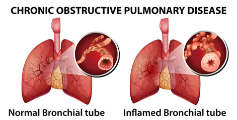 Chronic obstructive pulmonary disease - obrazy, fototapety, plakaty