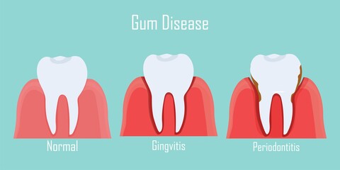 Fototapeta premium Teeth infographic Gum disease stages gingivitis and periodontitis. Editable vector illustration in flat style. Medical concept in natural colors on background. Keep your teeth healthy