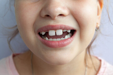 the girl smiles in close-up. there is no tooth at the top, and the front teeth are large.