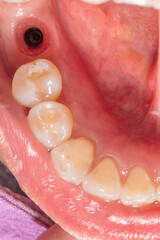 Gingival cuff after remove healing abutment from dental implant