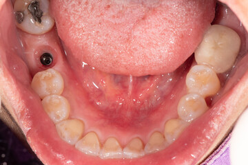 Gingival cuff after remove healing abutment from dental implant