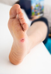 Naklejka premium Foot corn