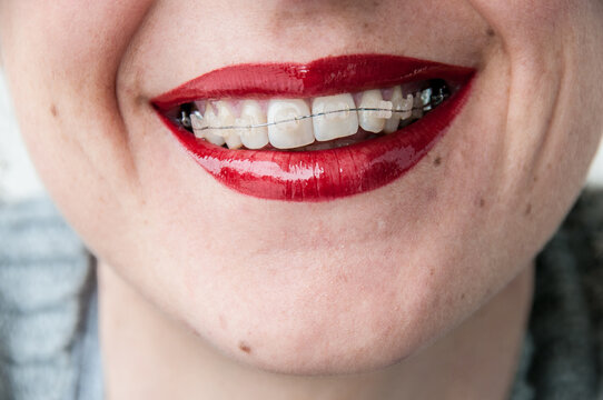 Girl with braces on teeth with red lips