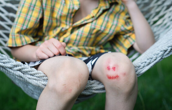 Little boy's skinned knee is smiling