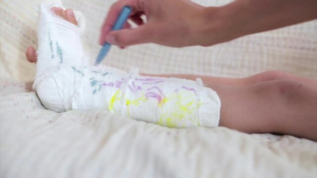 broken leg. damage to the bones. a child paints a plaster. a girl with a marker