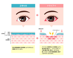健康な目とドライアイの目の比較イラスト
