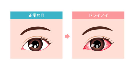 健康な目とドライアイの目の比較イラスト

