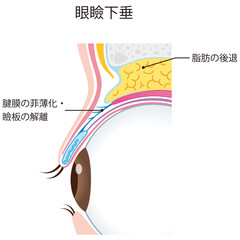 眼瞼下垂　瞼の構造　眼球　断面