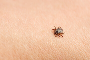Blood-sucking pest ixodid tick on the human body close-up