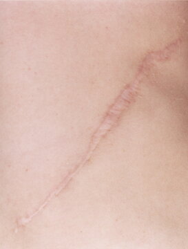 Scar