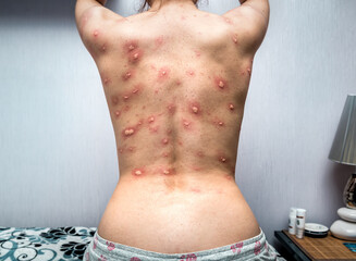 allergies on the female back