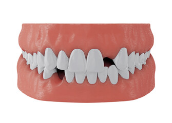 jaw with missing front upper tooth deuce and lower tooth three on white background, 3d render