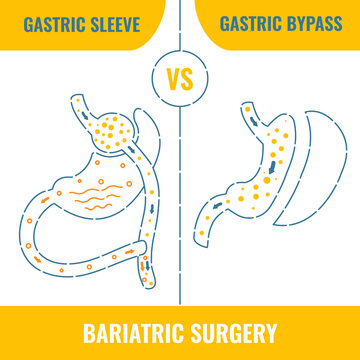 Gastric sleeve vs gastric bypass. Bariatric surgery weight loss procedures comparison. Stomach reduction anatomical diagram infographics. Health care medical concept. Line vector illustration.