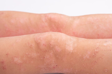 manifestation of dermatitis on the child body, rash on the legs close-up, redness on the skin, allergic reaction