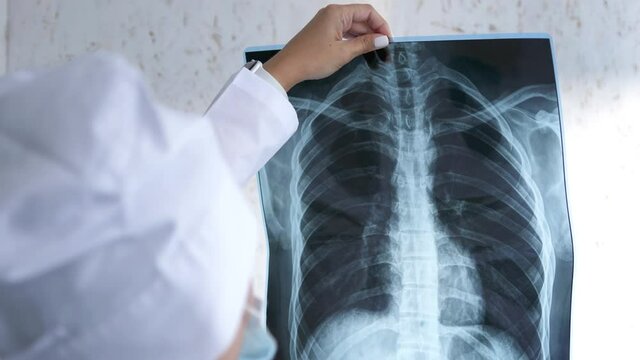 X-ray of the lungs in the hands of the doctor,the attending physician points his finger at the X-ray of the lungs to study the disease. Pulmonary edema,pneumonia.