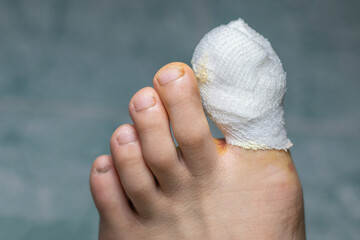 Bandage on the toes First aid for feet that have been fried nails from rot