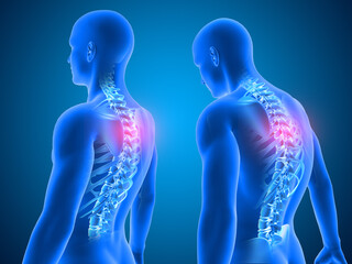 3D Medical background showing good and poor posture with spine highlighted - obrazy, fototapety, plakaty