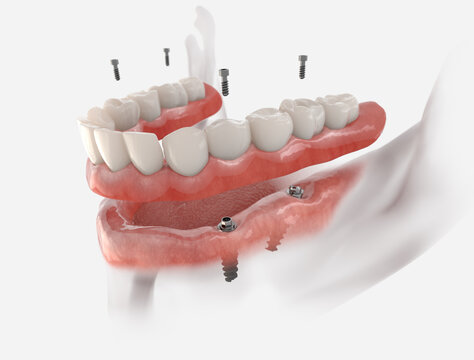 Mandibular fixed restoration with 4 implants, posterior are tilted.  3d illustration of implant on white background. Dental prosthetic innovation.