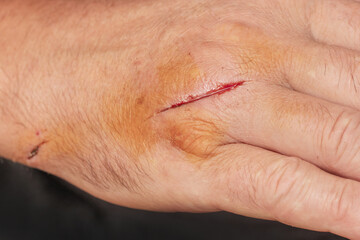 Cuts on a man's arm close up
