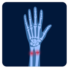 Fracture x ray concept