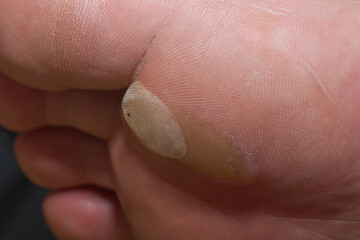 big white callus on a man's foot