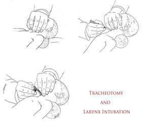 Healthcare and medicine: tracheotomy and larynx intubation, three steps drawings explaining how to perform the emergency operation