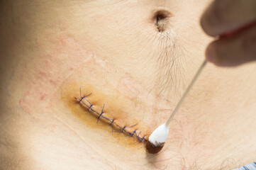 Nurse or Doctor hand treating the wound patient to clean the wound after stitches patients...