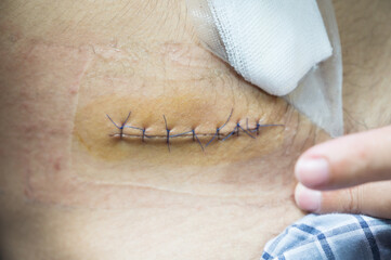 Nurse or Doctor hand treating the wound patient to clean the wound after stitches patients...