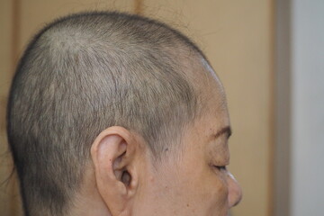 Obraz premium Side view of an old Asian woman with hair growth after finishing her chemotherapy course