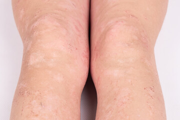 rash on children legs close-up, redness of the skin, allergic reaction