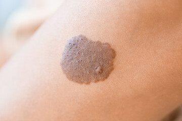 Birthmark on human skin, closeup