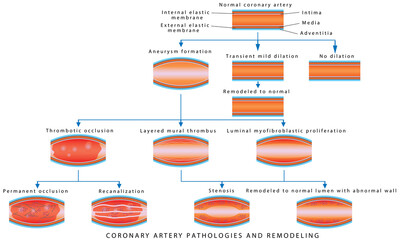 Coronary Artery Pathology. Arterial Remodeling. Medical illustration of Coronary Artery Pathologies and Remodeling. Coronary Artery Disease. 