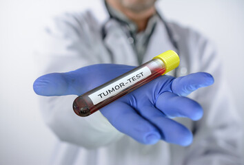 Doctor holds test tube with human blood for tumor test in hand