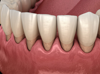 Gum recession process. Medically accurate 3D illustration