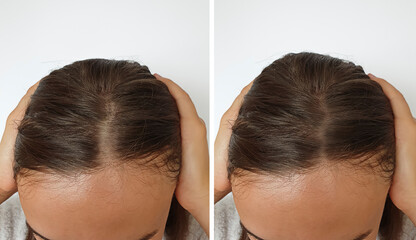 woman baldness hair before and after treatment
