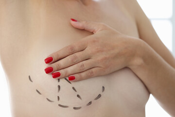 Doctor drew markers around breast in preparation for mammoplasty with surgical marker. Plastic...