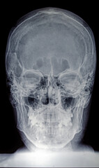 X-ray of the skull of an adult male