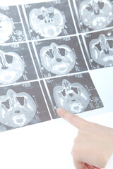 レントゲン写真を指さす女医