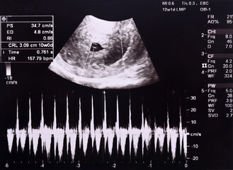 Ultrasound of Fetus - measuring heart baby rate