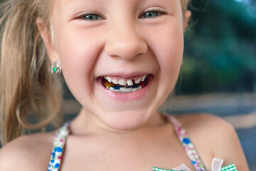 Little girl with orthodontics appliance and wobbly tooth