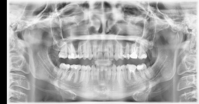 Dental x-ray of molars, crown, caries, implant. Magnetic resonance tomography of the oral cavity for braces.