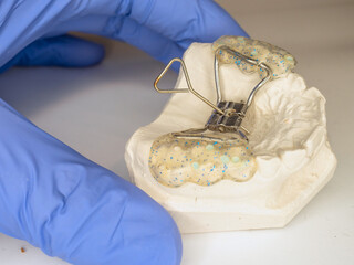 Teeth gypsum model with Hyrax Expander braces