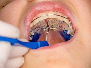 Doctor setting  with tool of Hyrax Expander RPE, Especial palatal braces for correction of birth defect.